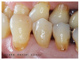 金属を使用しない透過性の高い材料　臼歯部