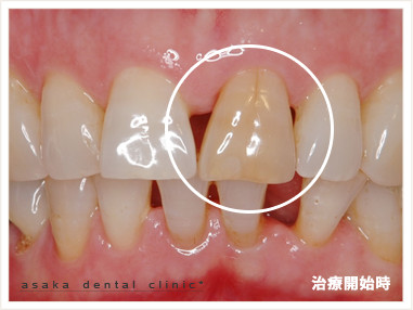 >前歯の変色に対する治療事例