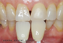色合わせを行います。周りの歯との色調の確認を行います。