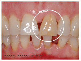 かぶせもの治療前