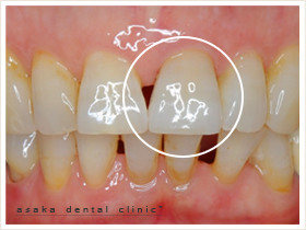 かぶせもの治療後