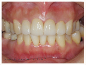 金属を使用しない透過性の高い材料　前歯部