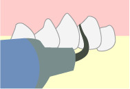 歯石の除去