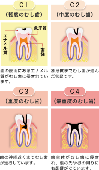 むし歯の進行