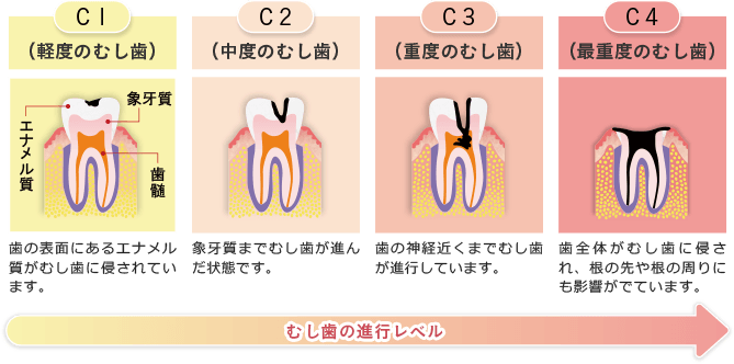 むし歯の進行