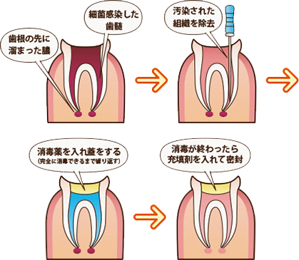 根管治療の流れ