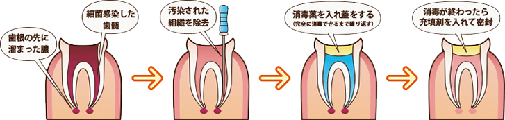 根管治療の流れ